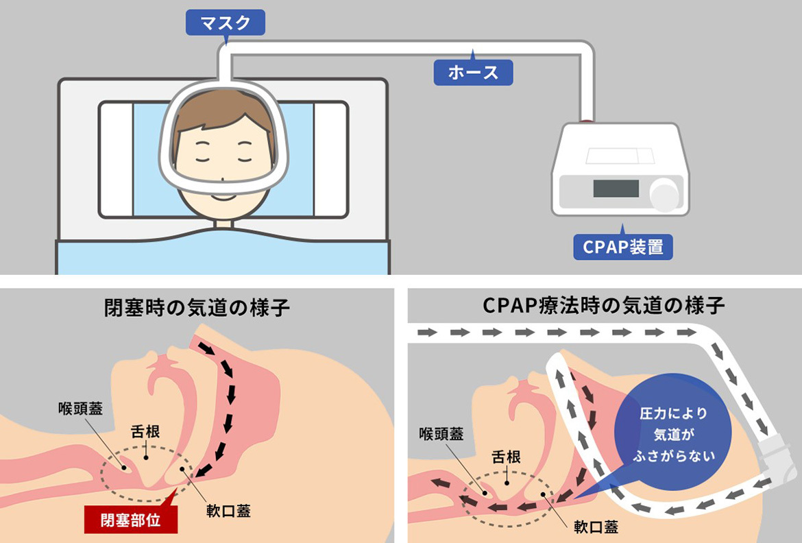 CPAP療法